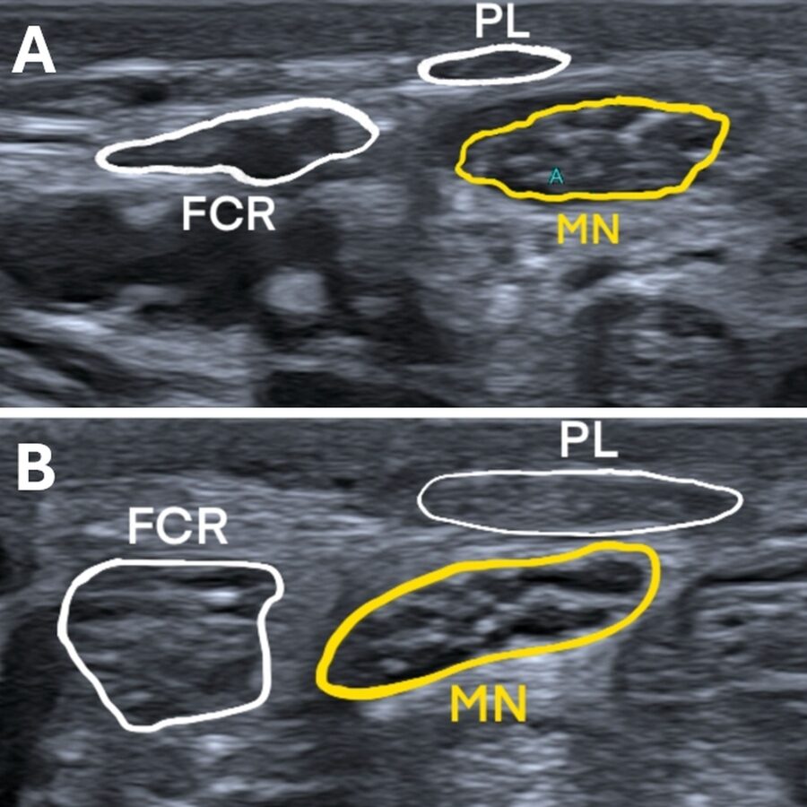Dynamická anatomie - ultrazvukový obrázek n. medianus