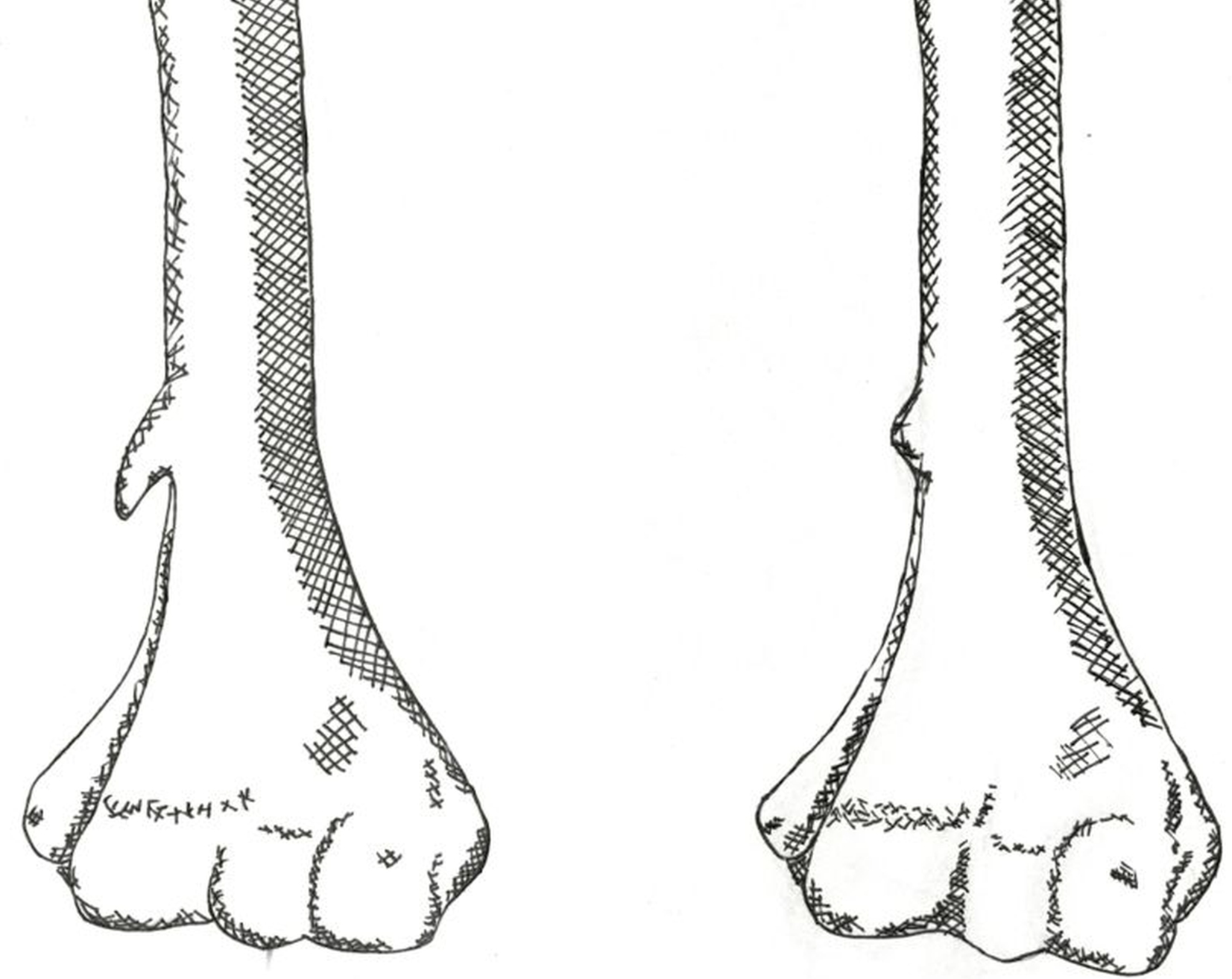 Anatomická variabilita ruky - distální část kosti pažní - processus supracondylaris a tuberculum supracondylaris