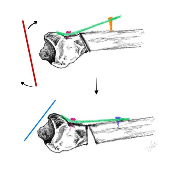 Biomechanika ruky a zápěstí - úprava sklonu při fraktuře distálního radia