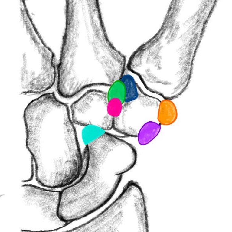 Anatomická variabilita - přidatné kosti ruky