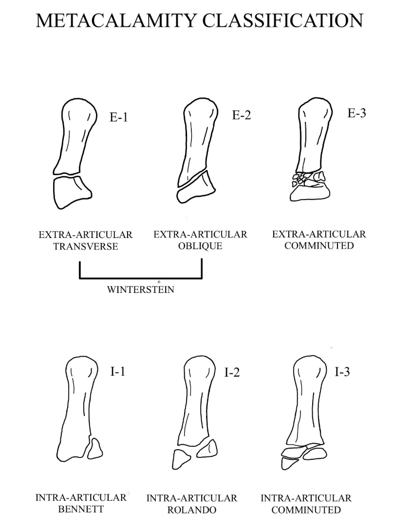 Metacalamity classification for first metacarpal base fractures